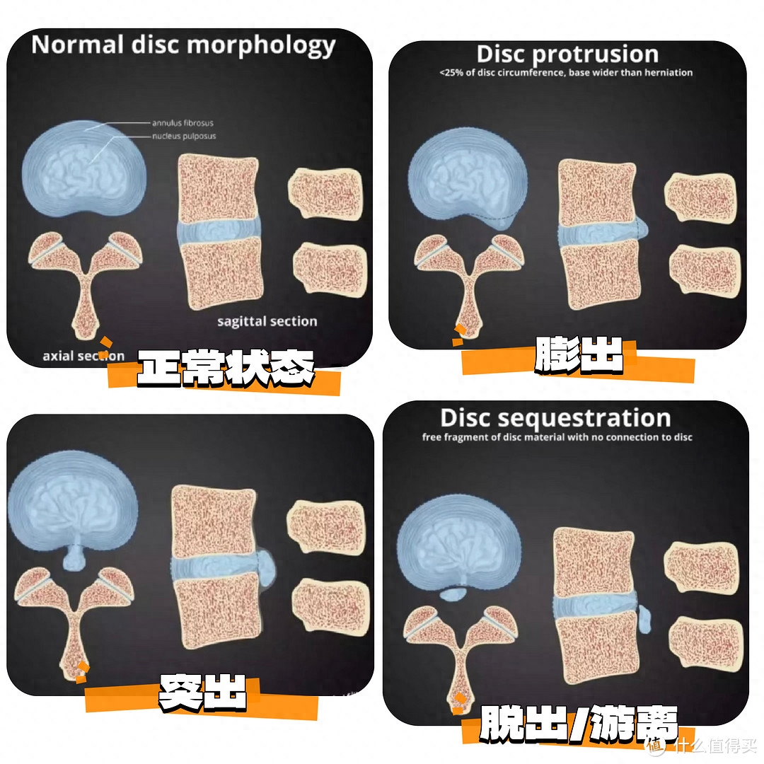 腰部疼痛预防及康复训练__如何预防腰痛病的再次发生